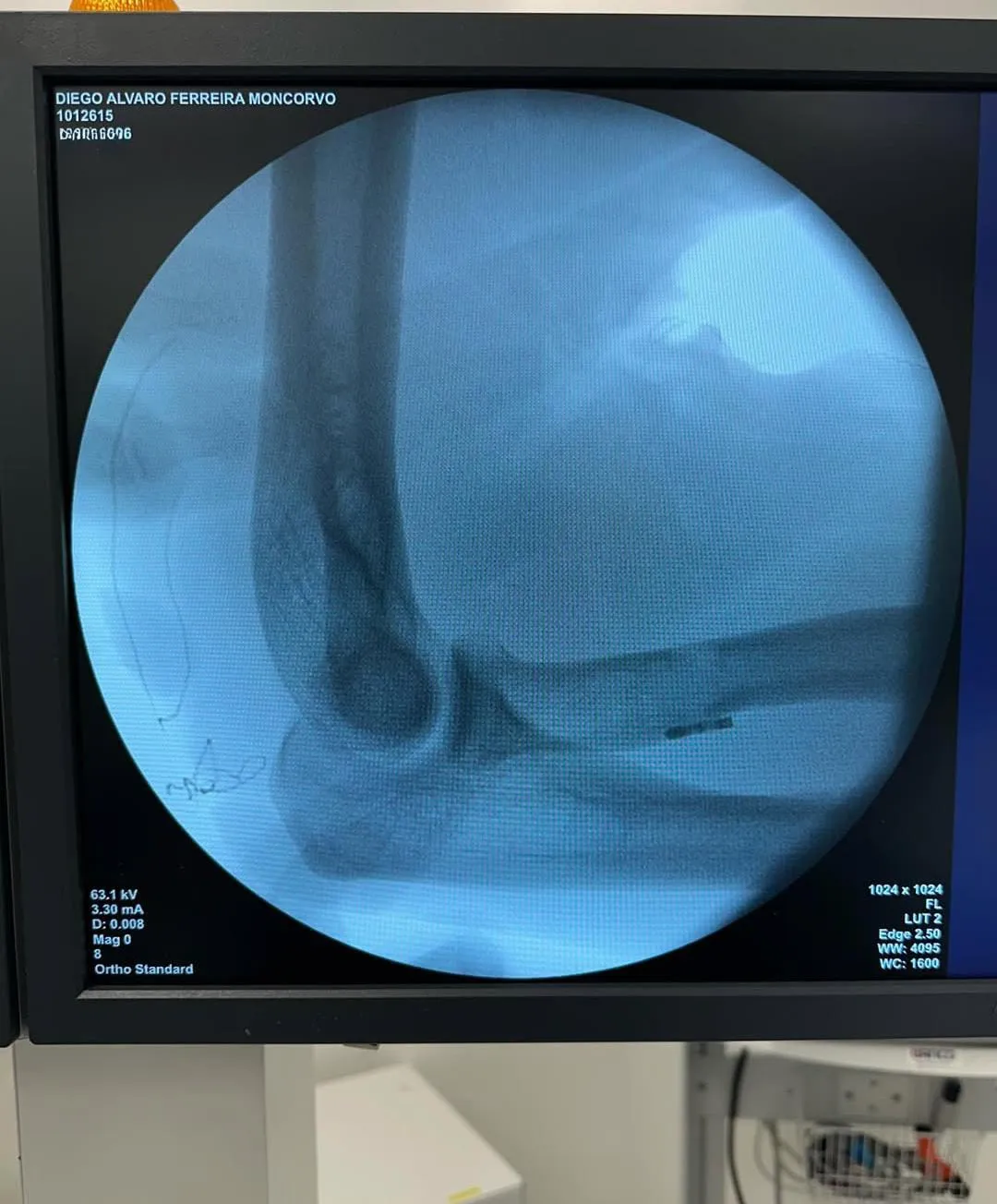 Raio X do braço divulgado por Baco