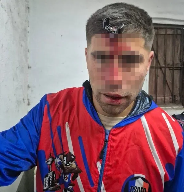 Imagem ilustrativa da imagem Bafafá em estádio acaba com chave de carro presa em crânio de jogador