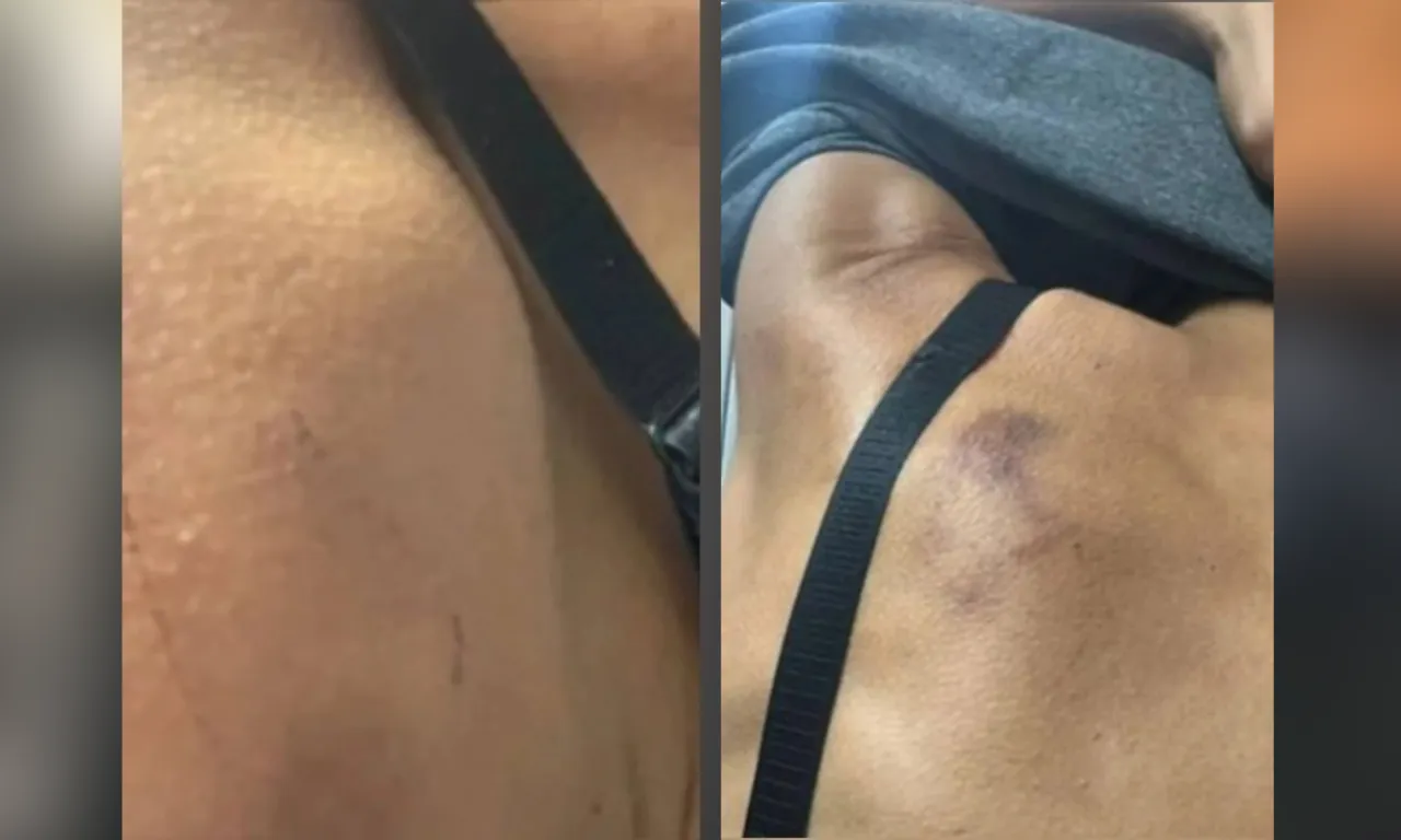Hematomas causados durante a tortura