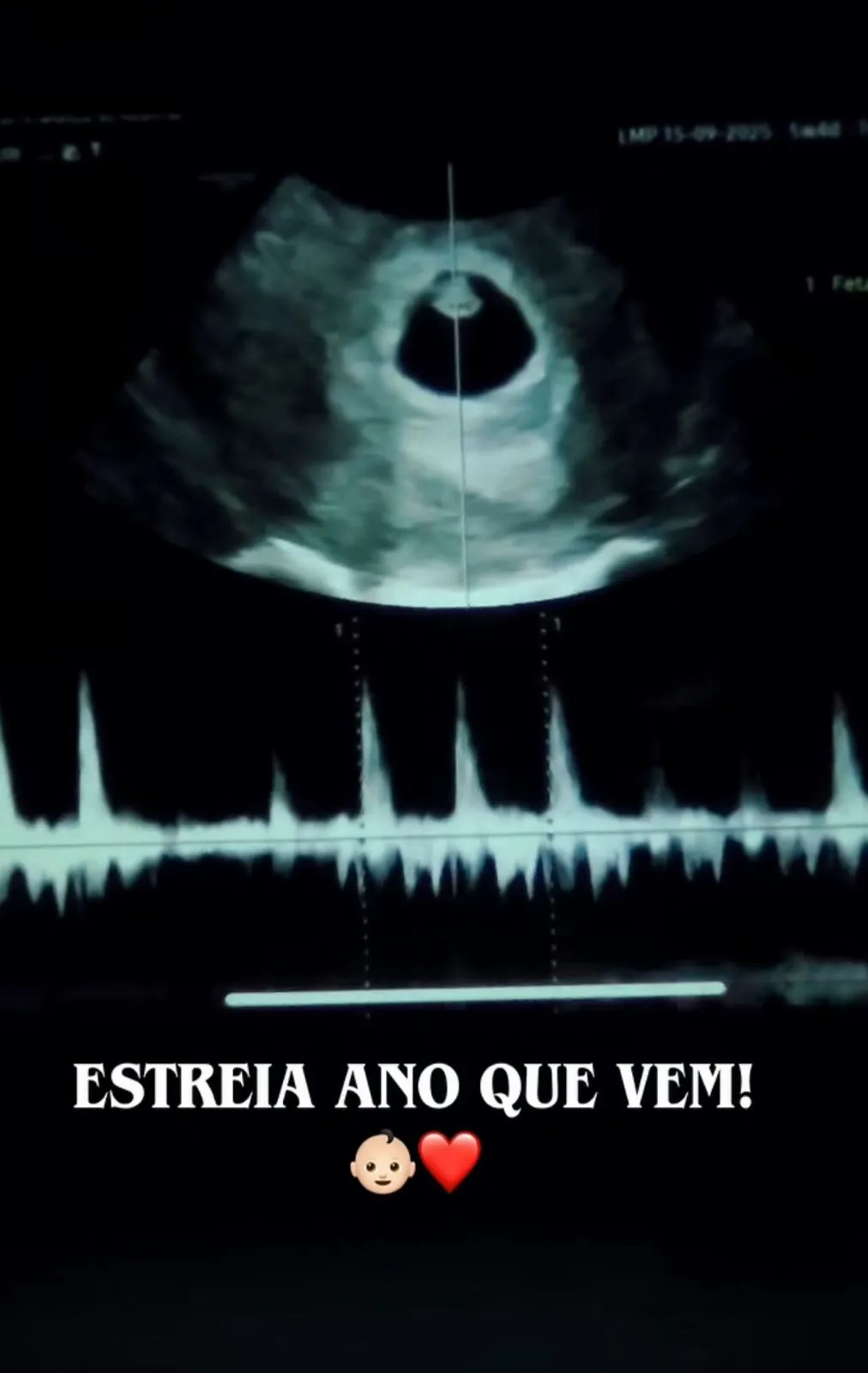 Imagem ilustrativa da imagem Ex-BBBs anunciam gravidez do primeiro filho: "Pegos de surpresa"