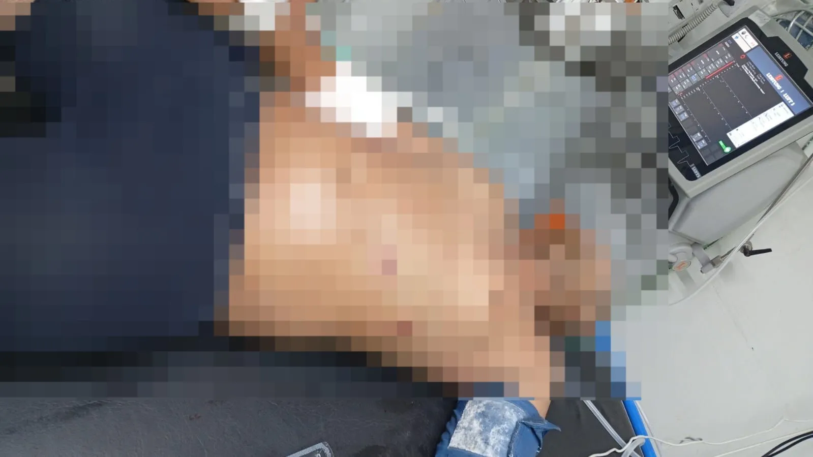 Há marcas de bala na região do abdomêm