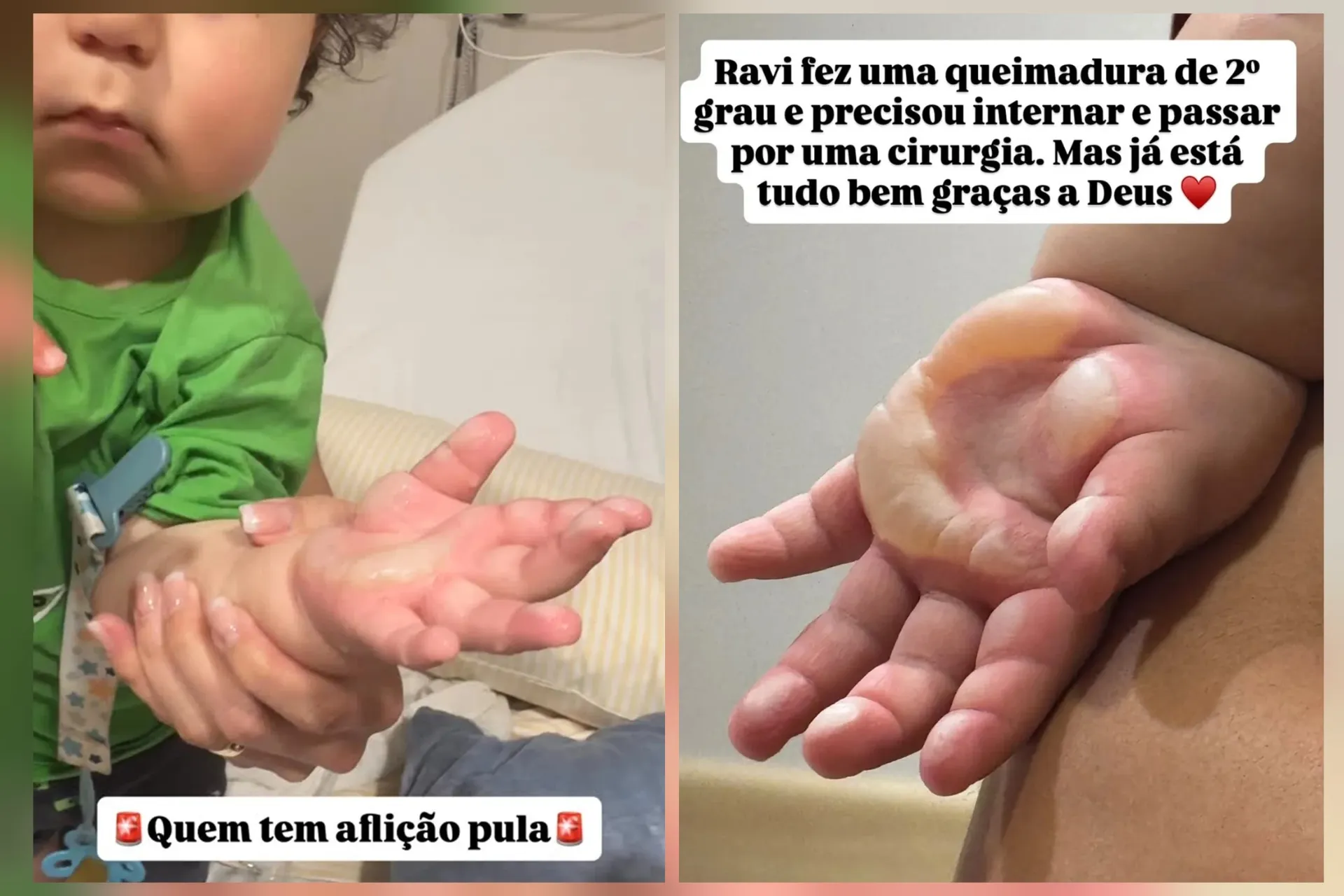 Ravi sofreu queimadura de 2° grau