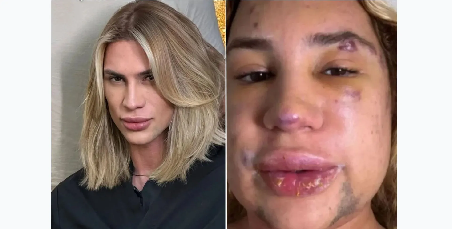 Imagem ilustrativa da imagem Influencer morre após fazer procedimento estético famosinho