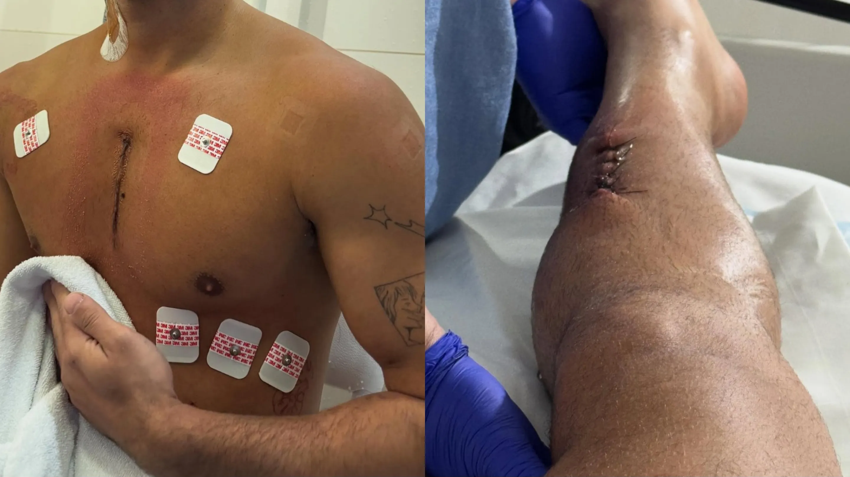 Vittor passou uma semana na UTI