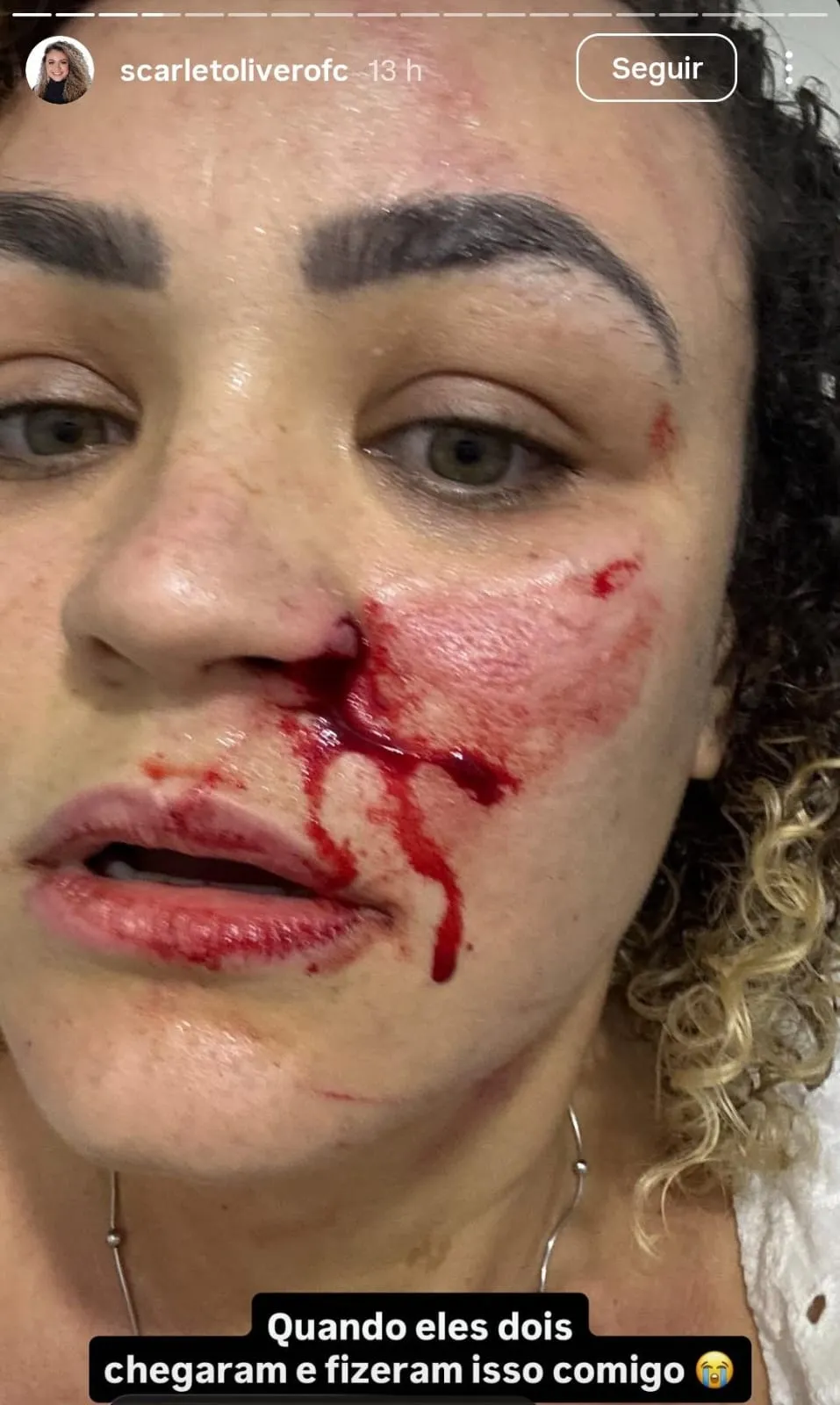 Mulher mostrou o rosto bem machucado