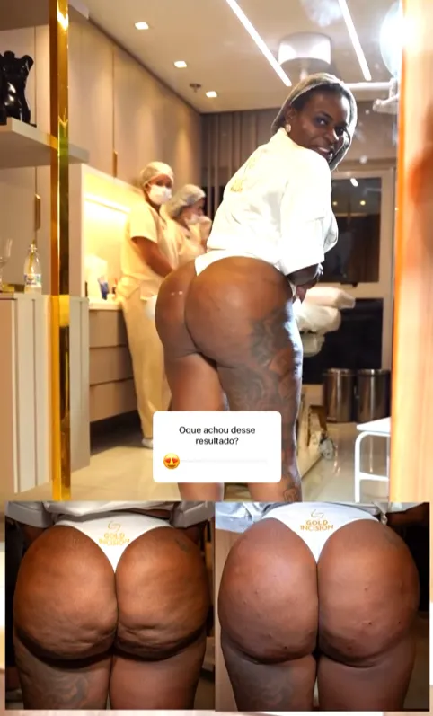 Antes e depois do bumbum da cantora Jojo Todunho