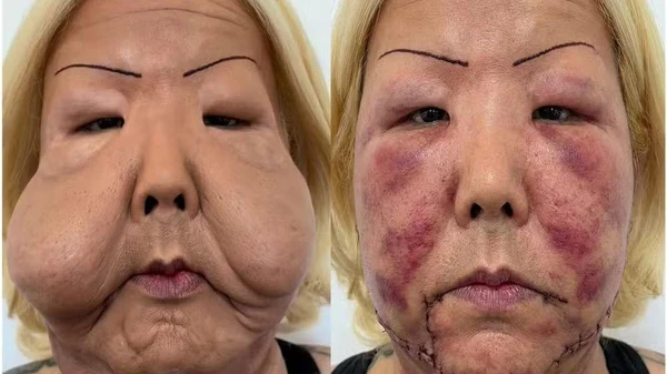 Imagem ilustrativa da imagem Juju do Pix entra na faca pra tirar óleo do rosto; veja antes e depois