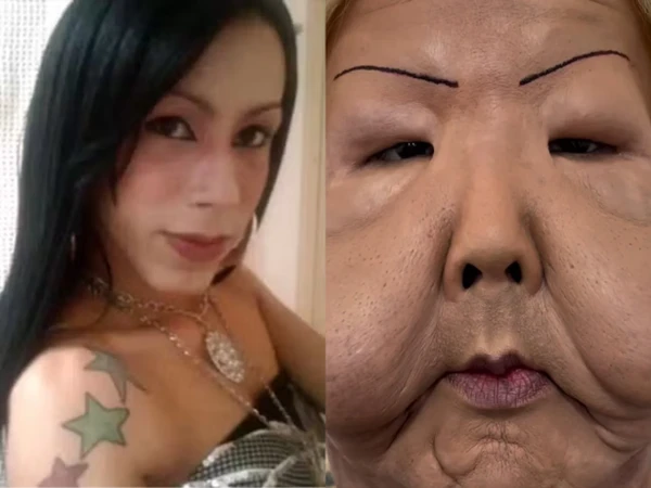 Imagem ilustrativa da imagem Juju do Pix entra na faca pra tirar óleo do rosto; veja antes e depois