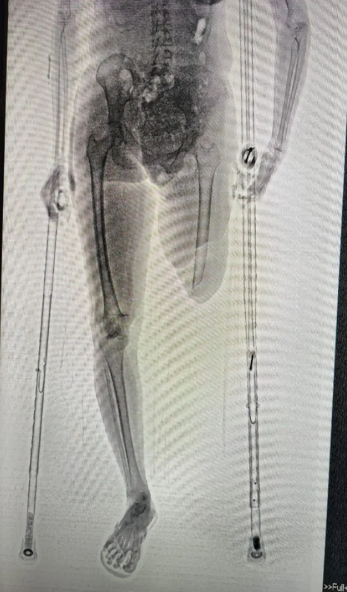 Resultado do scanner corporal BodyScan