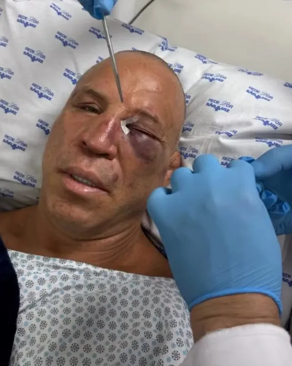 Wanderlei Silva ficou ferido após ser nocauteado