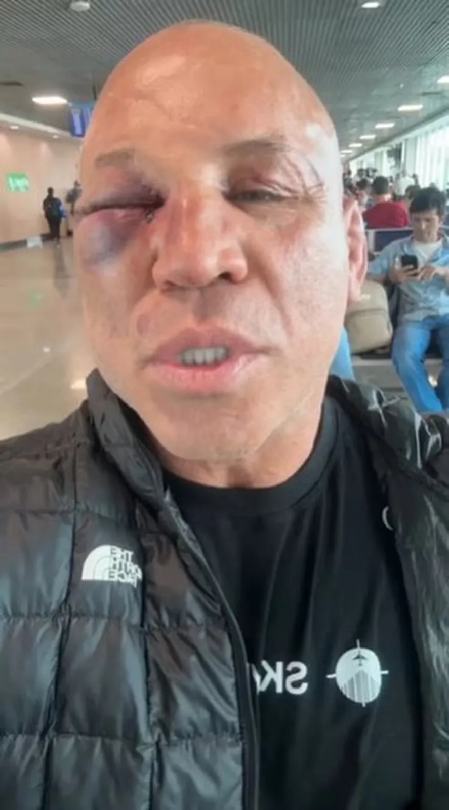 Wanderlei Silva ficou com olho inchado
