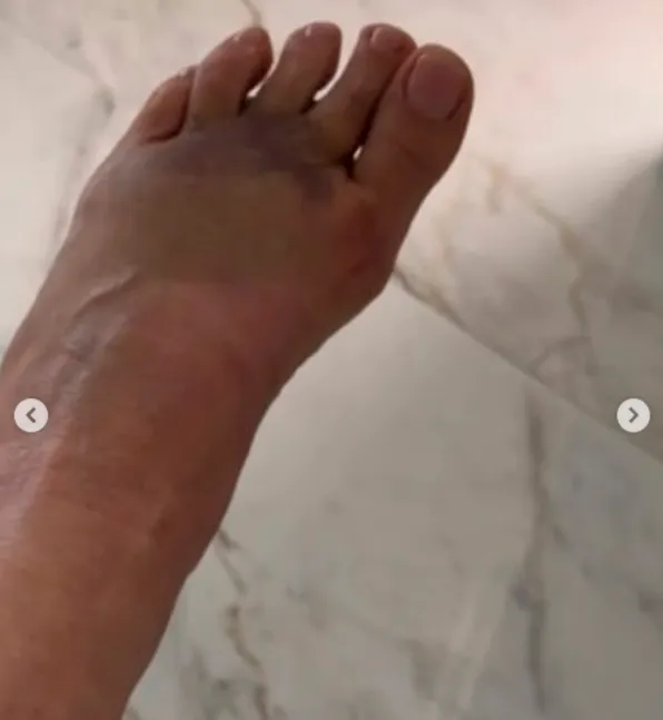 Zilu quebrou o pé após acidente dosméstico