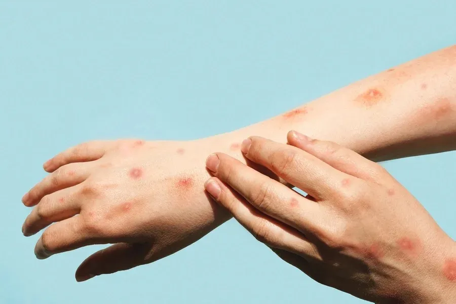 Foto Ilustrativa, Mpox sintomas iniciais