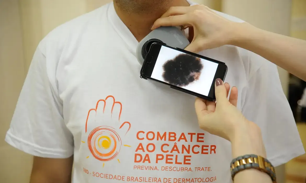 Pesquisas sobre vacina contra melanoma avançam