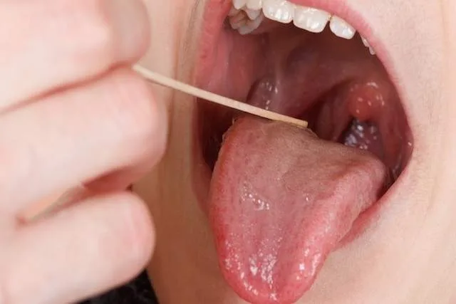 Alteração na mucosa pode ser sintoma da doença