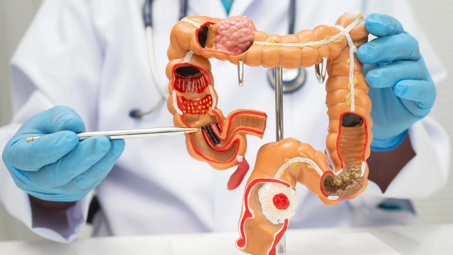Com uma incidência crescente a partir dos 50 anos, o tumor colorretal se desenvolve no intestino grosso, também chamado de cólon, ou no reto